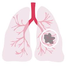 Sids is the leading cause of death in otherwise healthy infants. Lung Cancer Overview And More