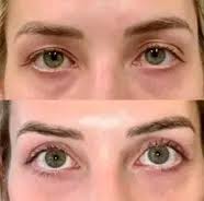 Denver's Eyelid Surgery Specialist