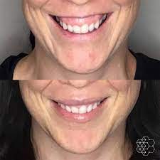 How to fix a gummy smile with lip fillers. Gummy Smile Skin Technique