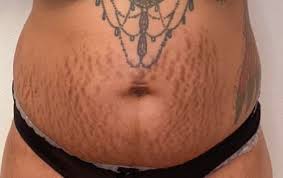 Tummy tuck scar tattoo 11. Will A Tummy Tuck Lipo Ruin My Tattoos Photo