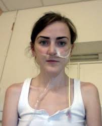 Double lung transplant graduate to run marathon