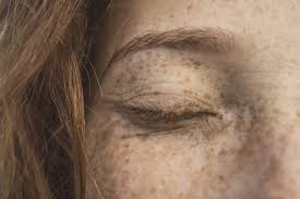 Image result for Freckles