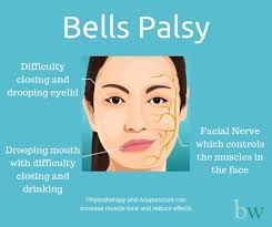 Bell's palsy can be a frightening experience, appearing suddenly with symptoms that cause many people to think they're having a stroke. Acupuncture For Bell S Palsy Mondeor Centre For Integrative Medicinemondeor Centre For Integrative Medicine
