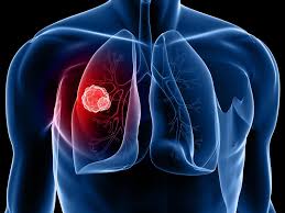 The doctor may then perform a physical examination and a spirometry test. Researchers Find Out Specific Blood Test To Treat Lung Cancer