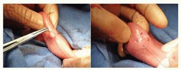 Six patients underwent 7 witzel gastrostomy procedures. Feeding Jejunostomy Basicmedical Key