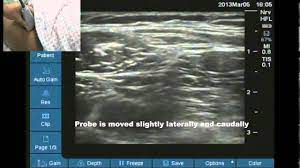 We did not find results for: Ultrasound Location Of Lateral Femoral Cutaneous Nerve Youtube