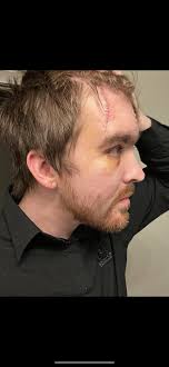 Fundraiser by Frank Bass : Help Frank Overcome Facial Neuropathy