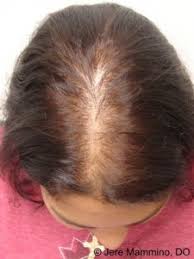 Kebanyakan farmasi di malaysia mempunyai ubat rambut gugur. Punca Keguguran Rambut Di Kalangan Wanita Dr Zubaidi Hj Ahmad Menulis