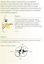 Most melanomas begin in the skin, though they can also occur in the eye. What Is Mohs Micrographic Surgery