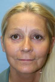 Facelift Before and After Photos by Scott Holley, MD; ,