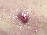 Their shape and color are less. Merkel Cell Carcinoma Memorial Sloan Kettering Cancer Center