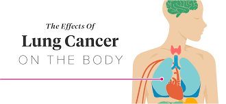 Lung cancer is the deadliest type of cancer, causing more than 150,000 deaths annually in the united states. Effects Of Lung Cancer On The Body