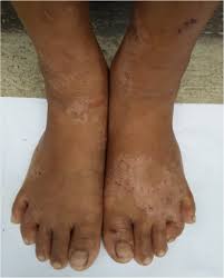 Image result for brown patches on the feet
