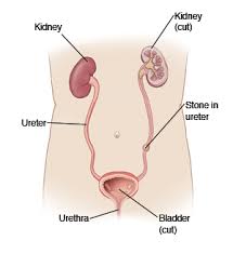 Kidney Stone Undescended No Symptoms