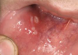 Oral infections are very common. Gingivostomatitis Babycenter