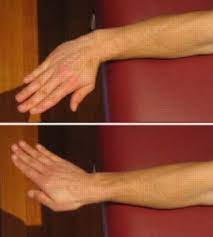 Although ganglion cysts typically appear on the back of the wrist,. Sprained Wrist Wrist Sprain Physioadvisor