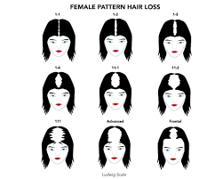 We Work With All Types Of Female Pattern Baldness Don T Hesitate To Call Us Our Focus Is Your Confidence Schedule A Consultation Today Hairloss Hairl