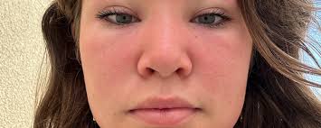 Run for dermatomyositis