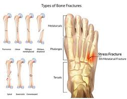 It is in the 4th metatarsal bone.like the toe beside the baby toe. Metatarsal Foot Stress Fractures General Discussion Forums Page 1