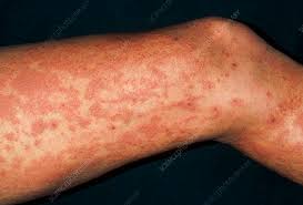Image result for allergy rash on the legs