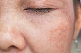 Your skin gets its color from a pigment called melanin. Prevent And Treat Hyperpigmentation Dr Stuart Miller