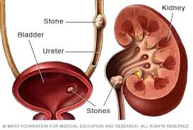 Calcium oxalate, uric acid, struvite. Kidney Stones Symptoms And Causes Mayo Clinic