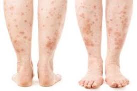 Image result for allergy rash on the legs