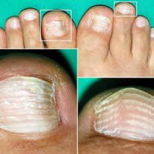 Image result for Beau lines feet