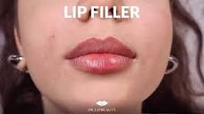 Filler labbra Acido Ialuronico Dr Lipbeauty - YouTube