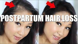 How long does postpartum hair loss last? How To Hide Postpartum Hair Loss Youtube
