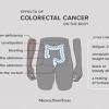 Over time, some polyps may turn into cancer. 1