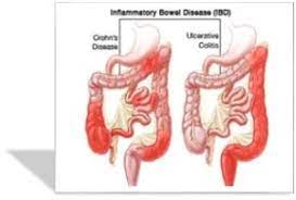 Inflammatory Bowel Disease Flashcards Quizlet