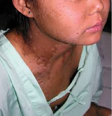 Figure 2 From Staphylococcal Scalded Skin Syndrome In An Adult Patient With Lupus Nephritis A Case Report And Literature Review Semantic Scholar
