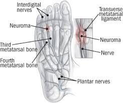 Toe numbness is an abnormal condition in which you feel a loss of sensation in the toes. Morton S Neuroma Harvard Health
