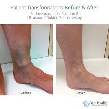 Pin By Ariel Frazier On Patient Vein Coordinator Endovenous Laser Ablation Sclerotherapy Vein Health