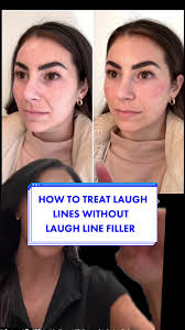 Before treating your laugh lines consider getting cheek and pyrifrom  filler. Volume