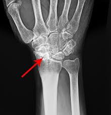 Image result for Scapholunate Dislocation