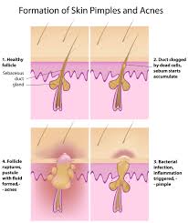 Ever wondered why you get those annoying red spots on your arms which look like permanent goose pimples? Naturopathic Beauty S Top 10 Tips To Treat Acne