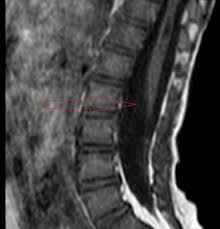 Image result for Dysraphism