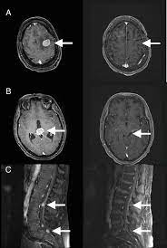 1 фраза в 1 тематике. Cureus Case Report Of Bone Marrow Sparing Proton Therapy Craniospinal Irradiation For Central Nervous System Myelomatosis