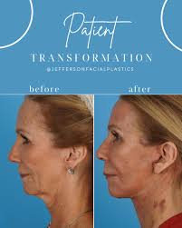 Your team at Jefferson Facial Plastics is renowned for the highest quality  and most innovative facial plastic surgery in the country! 💎 Call or visit  us online to schedule your consultation to