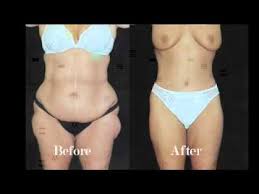 Pin On Gastric Sleeve