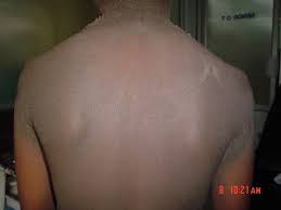 Both of them can be treated with local creams. Hyperpigmentation Wikipedia