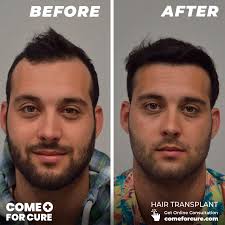 Hair Transplant Reviews