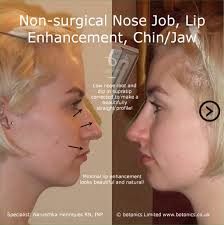 Non Surgical Nose Job Before After Photos Comparison In London Uk