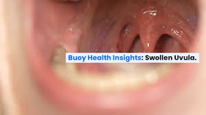 Image result for Uvulitis