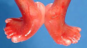 Reye's syndrome, acute hepatic encephalopathy, salicylic acid derivatives, children. Edwards Syndrome Diseases And Conditions Pediatric Oncall