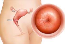The american cancer society guesses that around 12,900 new cases of this cancer will be diagnosed plus around 4,100 females will here are the top 11 warning signs of cervical cancer you need to know. Cervical Cancer Treatment From Top Hospitals In India
