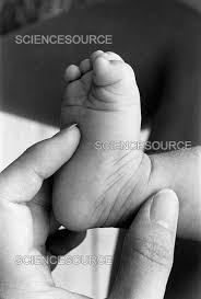 Image result for Babinski Reflex