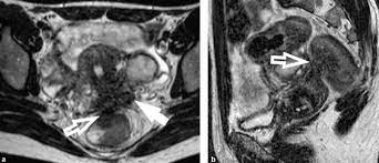 Endometriosis is a common condition where the tissue that behaves like the lining of the womb (the endometrium) is found outside the womb. Learning Curve In The Detection Of Ovarian And Deep Endometriosis By Using Magnetic Resonance European Journal Of Radiology